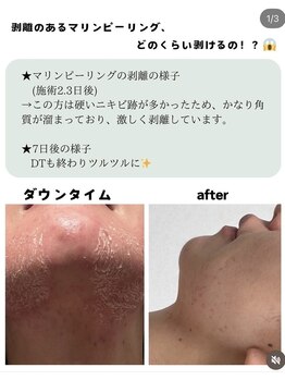 メイリリー 新宿(Meilily)/マリンピーリング