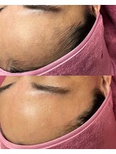 ホワイトワックス 沖縄店(WHITE WAX)/産毛を除去してツルツルに