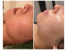 美しぐれ 溝の口店/【1年】プラズマ/ピーリング/MTS