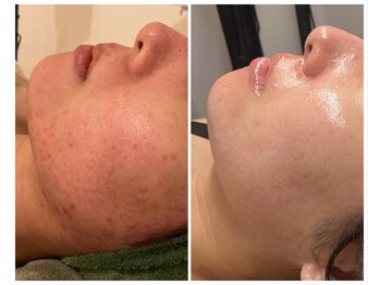 美しぐれ 溝の口店/【1年】プラズマ/ピーリング/MTS