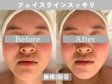 ミピマム 町田店/リフトアップ効果ちゃんと実感☆