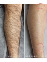 ブリリアント(Brilliant)/脱毛実績2 メンズ脚