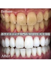 ホワイト 天王寺店(White)/Whitening症例before→after