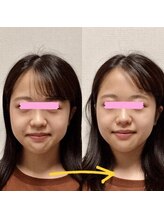 アレイズ/小顔矯正コース