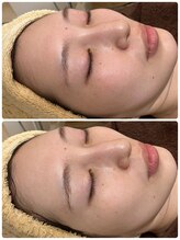 ジェニー(JENNI)/LDMエクソソーム導入 施術1回