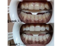 ホワイトニングセンター 大阪茨木店/高槻・茨木ホワイトニング