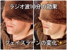 リエル(RIEL)/【ラジオ波エステ】