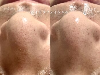 キアラ(CHIARA)/ハイドラフェイシャル