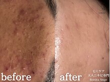ボニータアンジュ 恵比寿(Bonita Ange)/恵比寿ハーブピーリング｜症例
