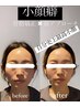 【小顔矯正】一発でびっくりするほど変わります。大人気メニュー
