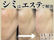 ラヴレボーテ(La Vraie Beaute)の雰囲気（岸和田久米田・加工なし当サロンシミ症例/シミケア・ツヤ・美白）