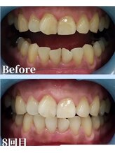 ガーディー(GaDaY)/８回来店【１０分照射×２回】