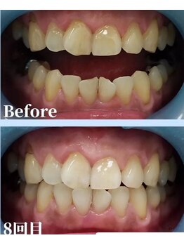 ガーディー(GaDaY)/８回来店【１０分照射×２回】