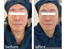 ネオファースト 大阪福島店(NeoFirst)/4Dフェイシャル#毛穴#毛穴洗浄