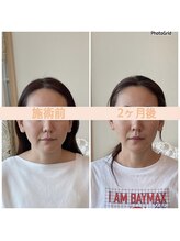 リフェイスフサエ(ReFace Fusae)/お顔の変化