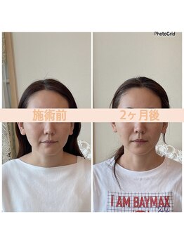 リフェイスフサエ(ReFace Fusae)/お顔の変化