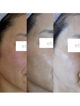 トラット エステアンドアイズ(tratto)/50代　お客様症例写真