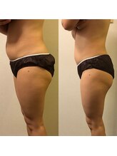 ラクーン 武蔵小杉(raccoon)/インディバ痩身☆