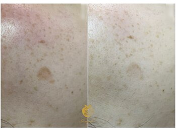 しらゆき 名古屋黒川/シミケア