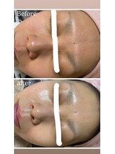 ココ(COCO)/シミケア、ビフォー、アフター