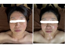 ヴィズクラブ バイ ビネル(Vi's CLUB by BINEL)/Before/After