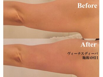 銀座ナチュラル スタイル (Natural Style)/ヴィーナスDIVAふりそで肉対策