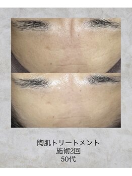 コンクパール(CONCH PEARL.)/陶肌トリートメント