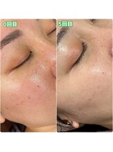 エリーザベル(Elisa Bell)/ハーブピーリング