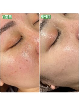 エリーザベル(Elisa Bell)/ハーブピーリング