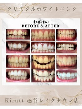 キラット 越谷レイクタウン店(Kiratt)/ビフォーアフター