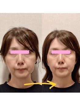 アレイズ/小顔矯正コース