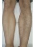 【メンズ脚丸ごと脱毛】大幅プライスダウン！！　両脚丸ごと¥5500