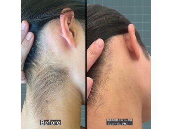 アレッド 大阪店(ared.)/密かに人気なうなじ脱毛