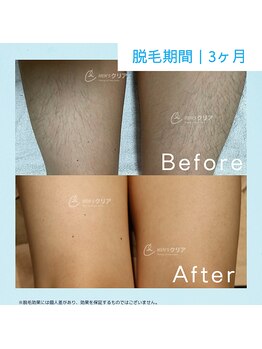 メンズクリア イオンモール東浦店/【メンズクリア】お客様の施術例