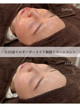 サロンベイア(salon Beia)/赤み改善トリートメント！