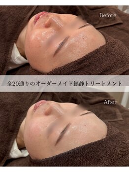 サロンベイア(salon Beia)/赤み改善トリートメント!