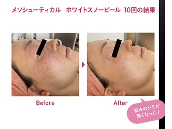 スイ 昭島店(Sui)/ホワイトスノーピール/シミ/美白