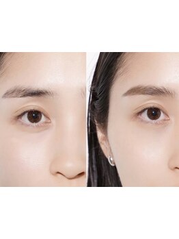 パーツ脱毛のできるサロン