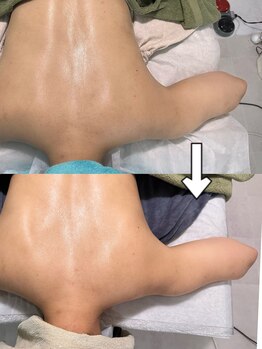 ルーチェ(LUCE)/ブライダル背中エステ