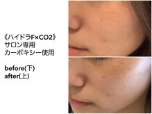 ディアメ(Diame)/古い角質や毛穴悩みにはこちら♪