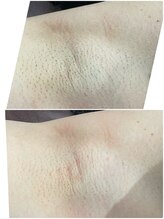 グロー(GLOW)/ワキ脱毛