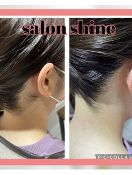 サロンシャイン(Salon Shine)/うなじ脱毛２０代前半女性