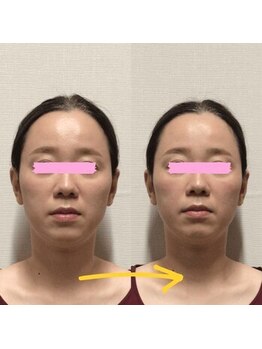 アレイズ/小顔矯正コース
