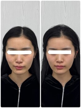 ラフテル鍼灸整骨院/小顔矯正×美容鍼でむくみ解消♪