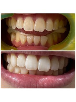 ワイズサロン(Y's salon)/1回目完了の症例写真です!