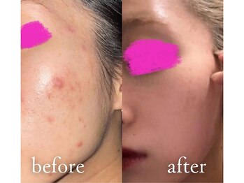 エトワール 横浜馬車道店(ETOILE)/肌質改善|ニキビ・毛穴ケア