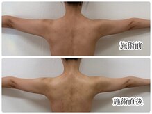 シェミー(CHEZ MEE)/ブライダルエステ（首・背中）