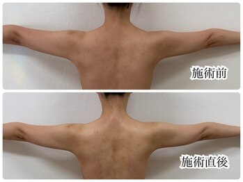 シェミー(CHEZ MEE)/ブライダルエステ（首・背中）