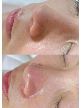 ユミサロン(U Mi Salon)/毛穴の詰まりプロ根元からクリア