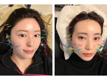 アム(aM)の雰囲気（顔のむくみ・フェイスラインの変化を実感できる美容鍼）